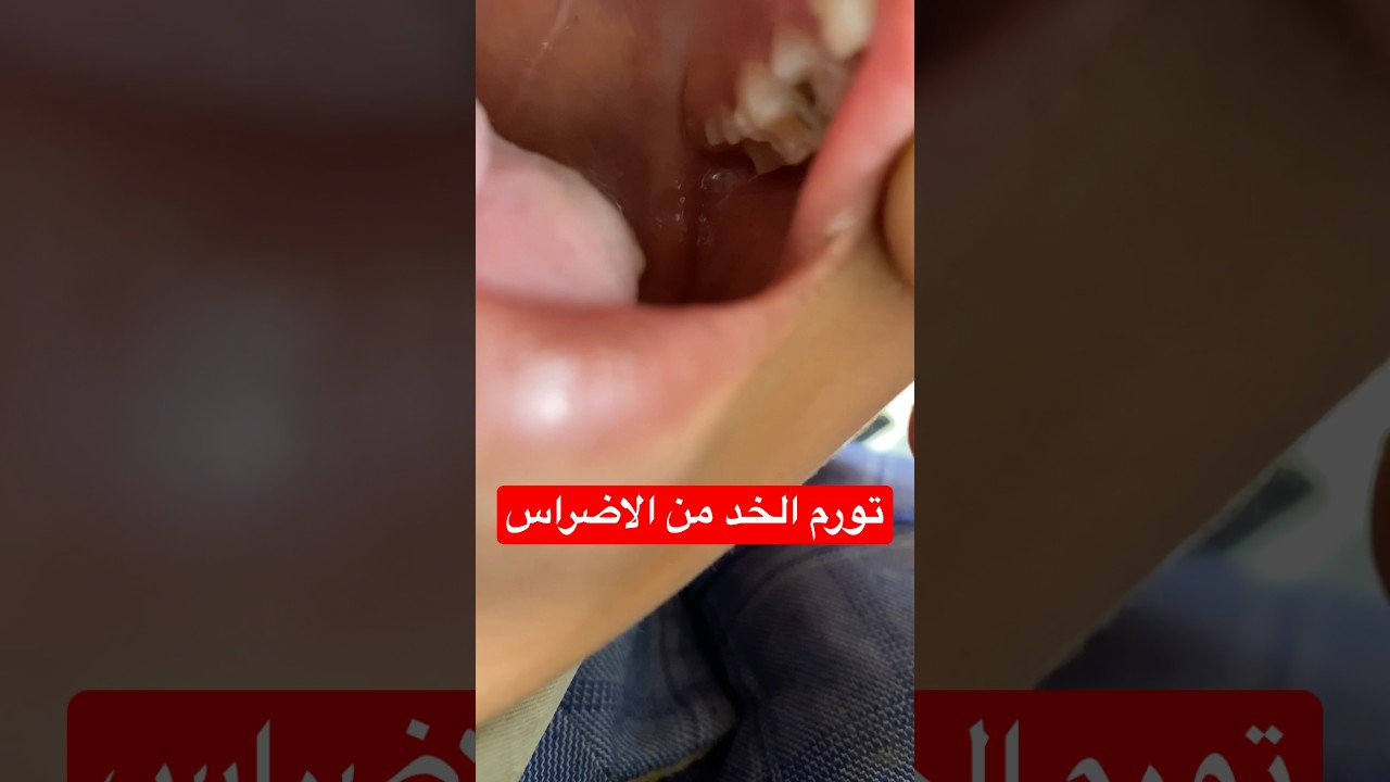 تورم الخد من تسوس الاضراس