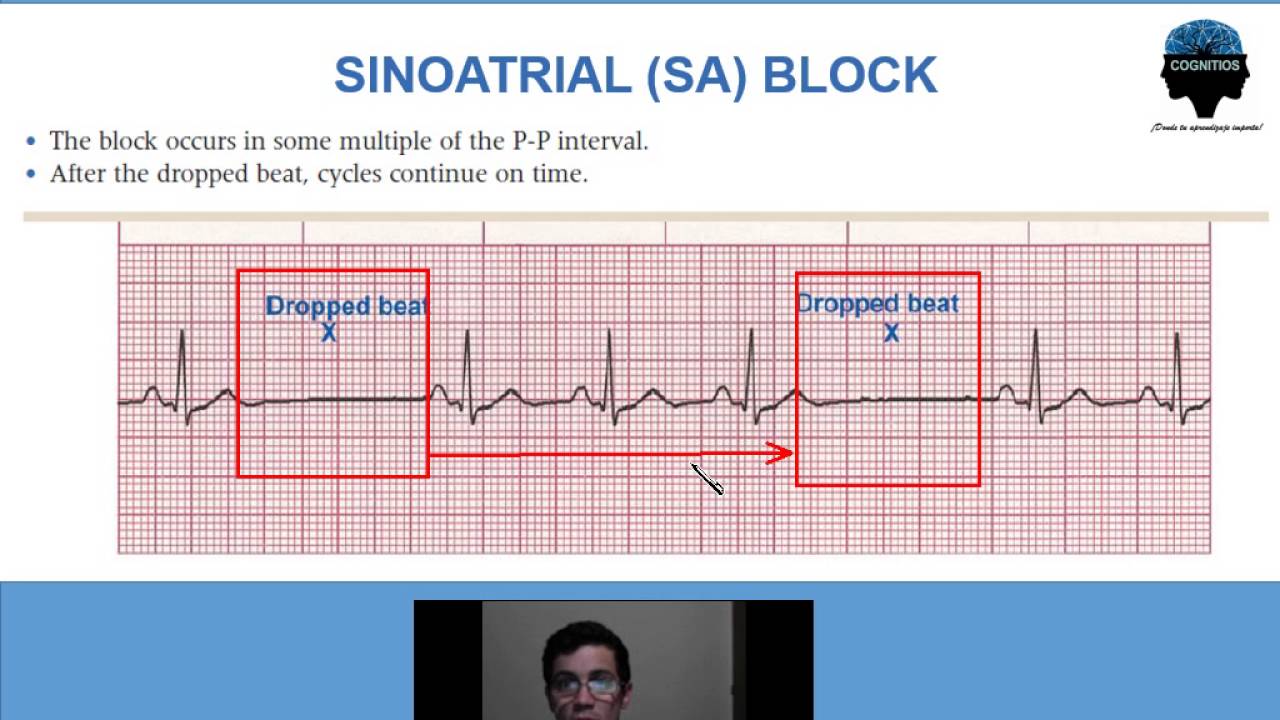 6  Bloqueo o Paro Sinusal