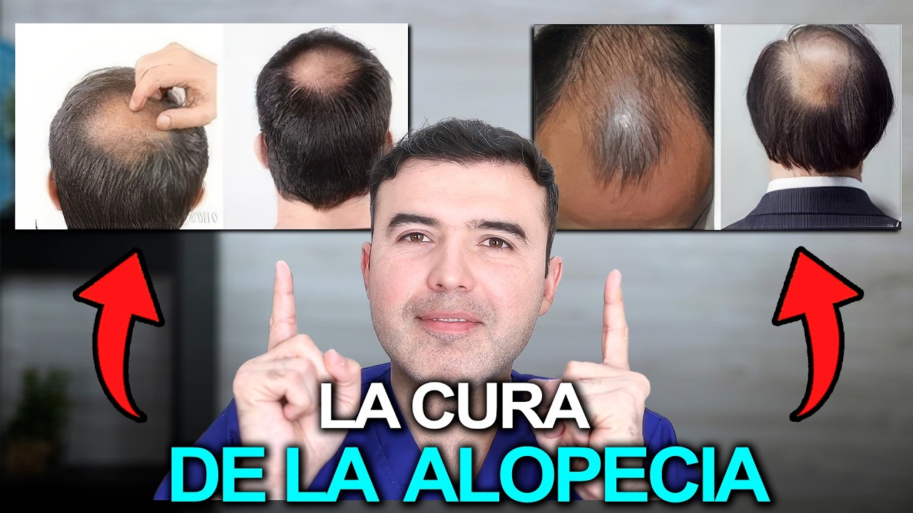 &iexcl;CURA la PERDIDA DE CABELLO Recupera tu CABELLO! 5 Soluciones que S&Iacute; FUNCIONAN (Resultados Reales)