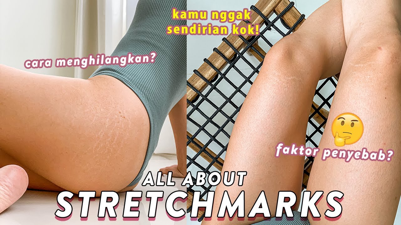STRETCHMARKS ROUTINE?! Cara Menghilangkan dan Mencegah timbulnya Stretchmarks
