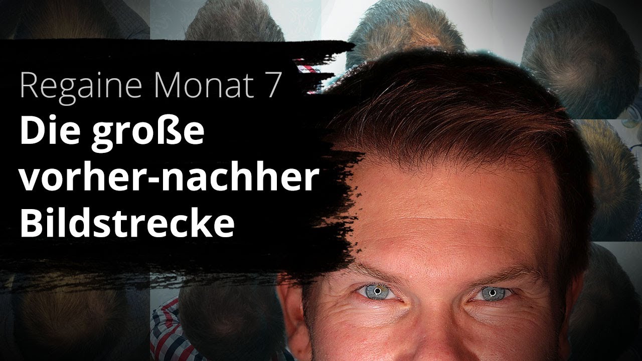 Regaine Monat 7 | Vorher-Nachher Vergleich mit Regaine