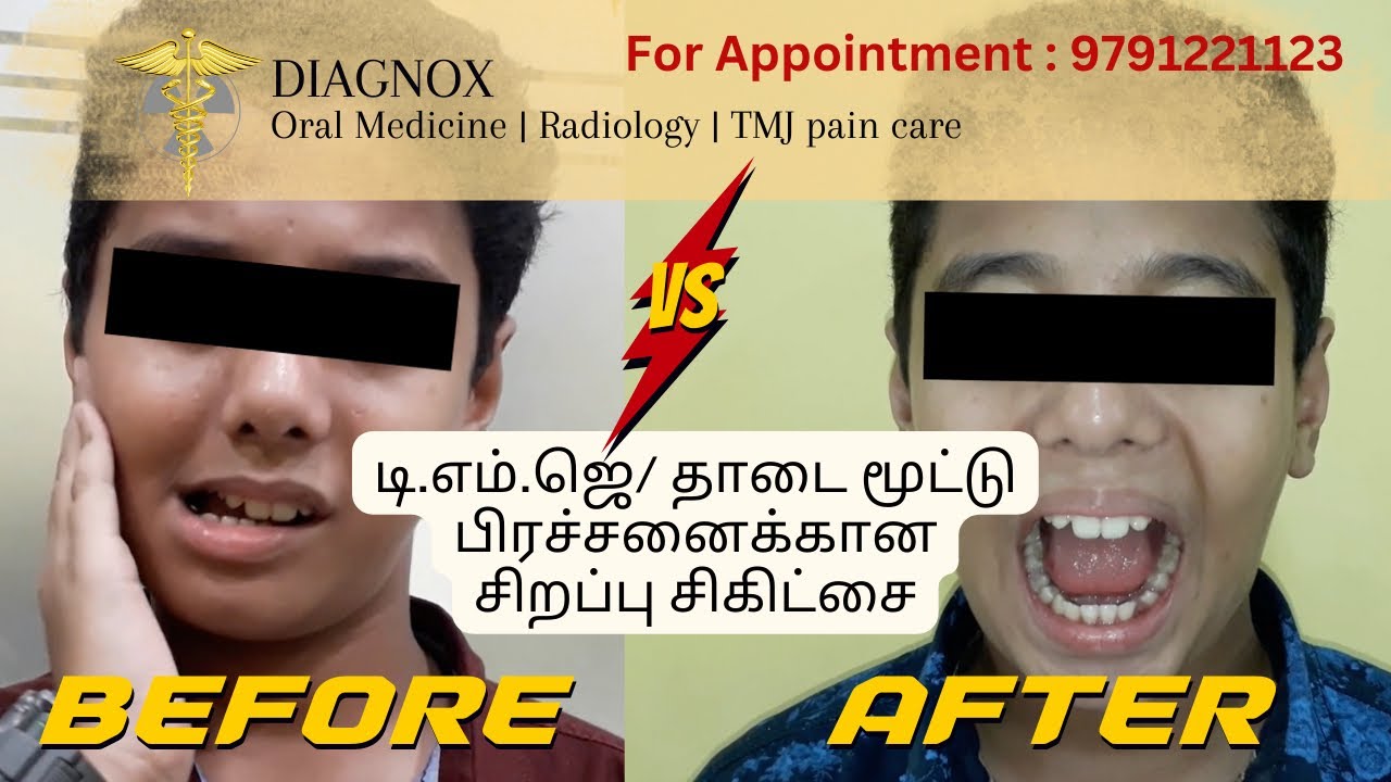 TMJ பிரச்சனைக்கான சிறப்பு சிகிட்சை (Specialized TMJ management)