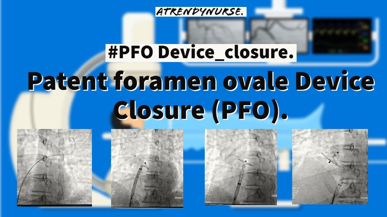 #pfo  #PFOclosure #cathlab #What_is_PFO  Patent foramen ovale Device Closure (PFO).