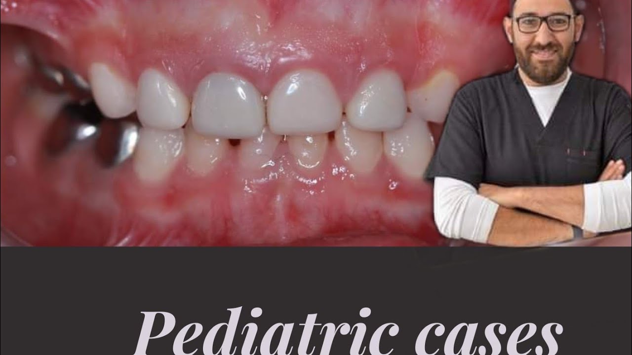 pediatric dentistry/ post&core of primary teeth / Dr. Ibrahim Mansour