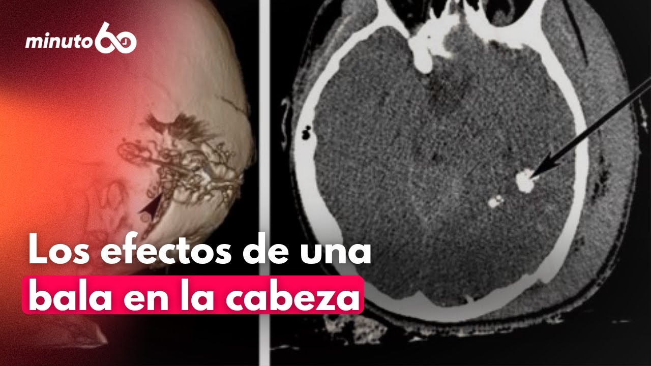 Caso Miguel Uribe: ¿Qué daños deja una bala en la cabeza? Un neurocirujano explica | Minuto60