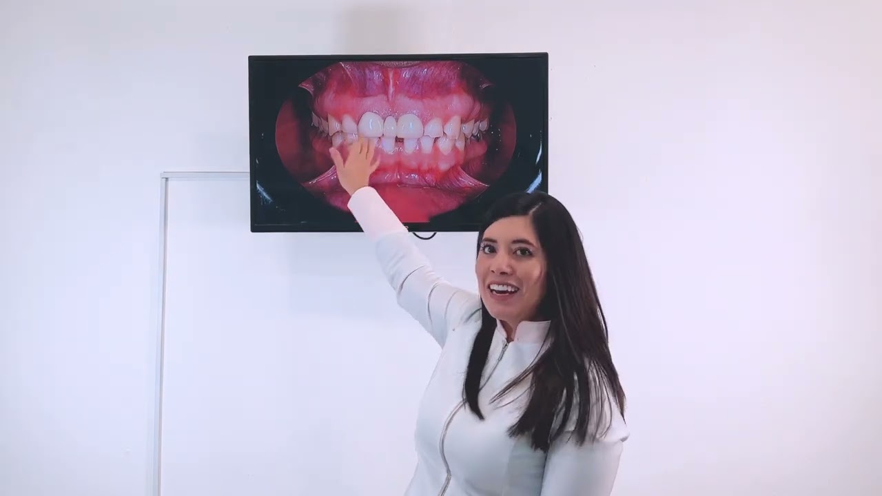 Si tienes espacios entre los dientes no permitas que te hagan esto 😨😨😳