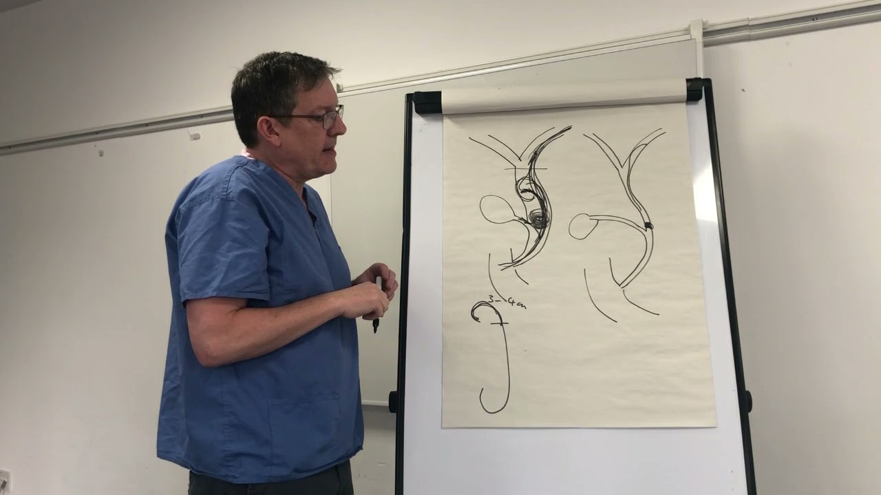 Полезные советы от GastroLearning: Стентирование желчного протока методом «косички»