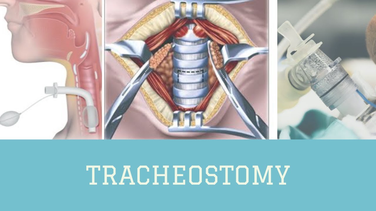 TRACHEOSTOMY | The White Army