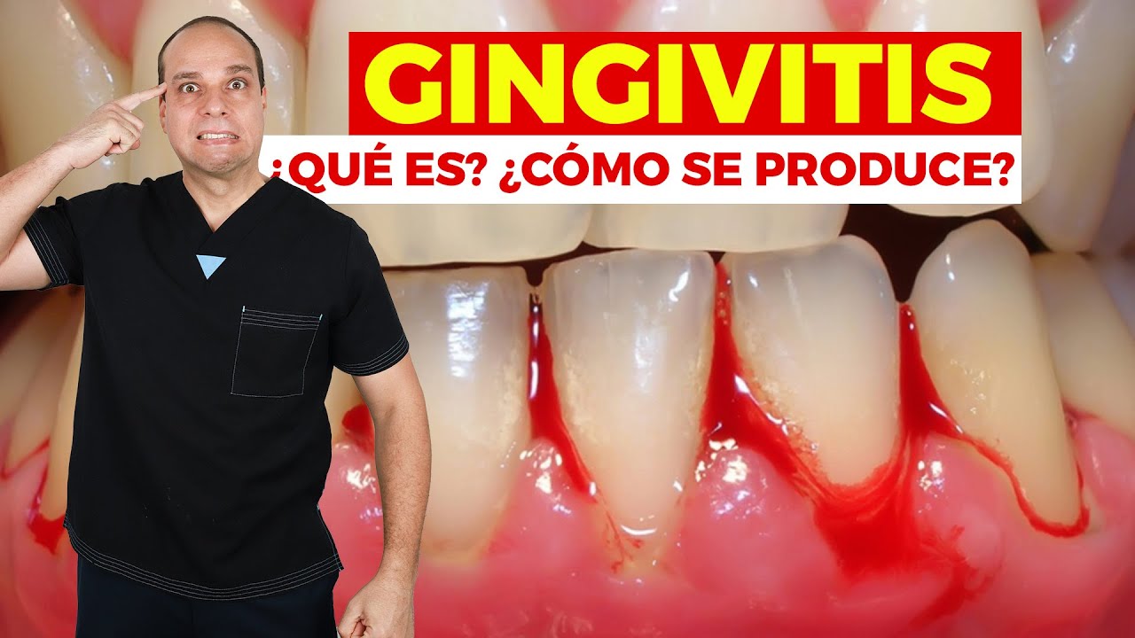 GINGIVITIS 😱 ¿Cómo se produce? 😰 ¿Cómo tratarla?