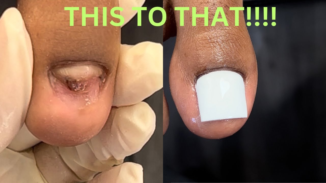 РЕКОНСТРУКЦИЯ ПАЛЬЦА | НАКЛАДНЫЕ АКРИЛОВЫЕ ПАЛЬЦЫ