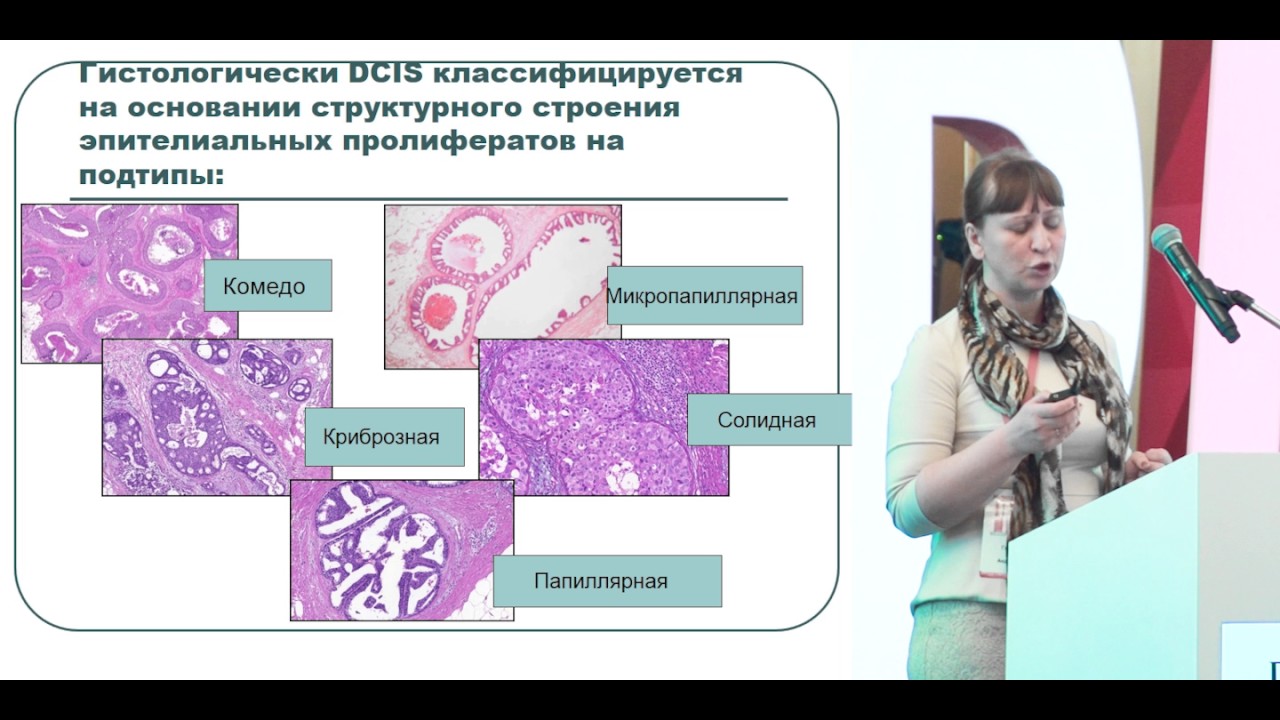 Протоковый рак in situ. Морфологические варианты и их клиническое значение