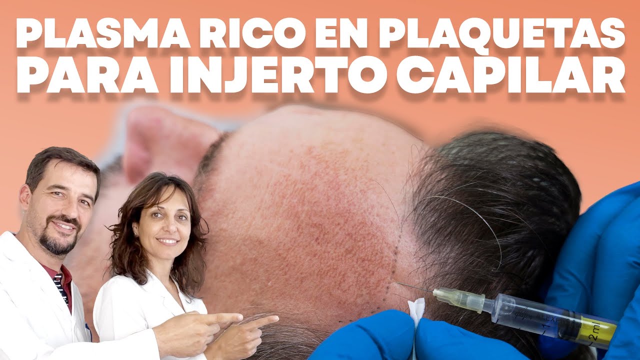 🔵 Plasma Rico en Plaquetas para Injerto Capilar 🔝
