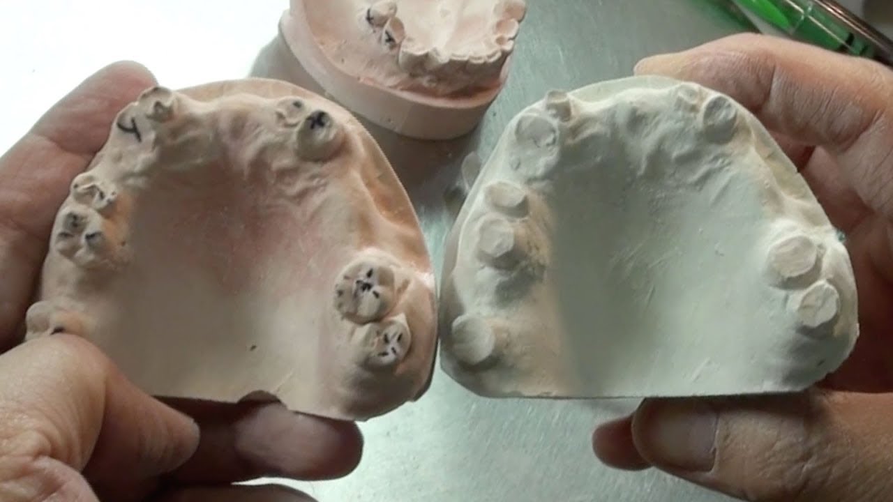 How To Do A Blueprint For A Full-Mouth Reconstruction | Dental Lab Learning