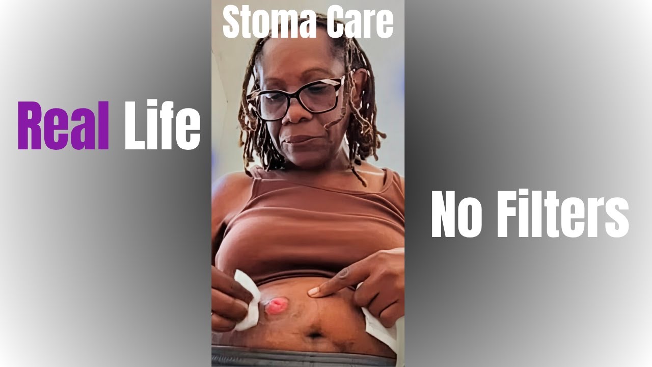 Caring for My Stoma: What Works for Me