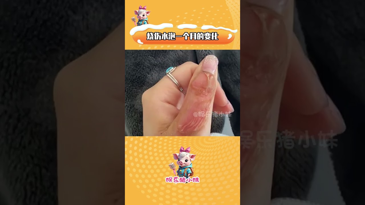 人類神奇的身體和免疫系統修復能力 #燒傷 #水泡 #萬萬想不到 #國外視頻分享