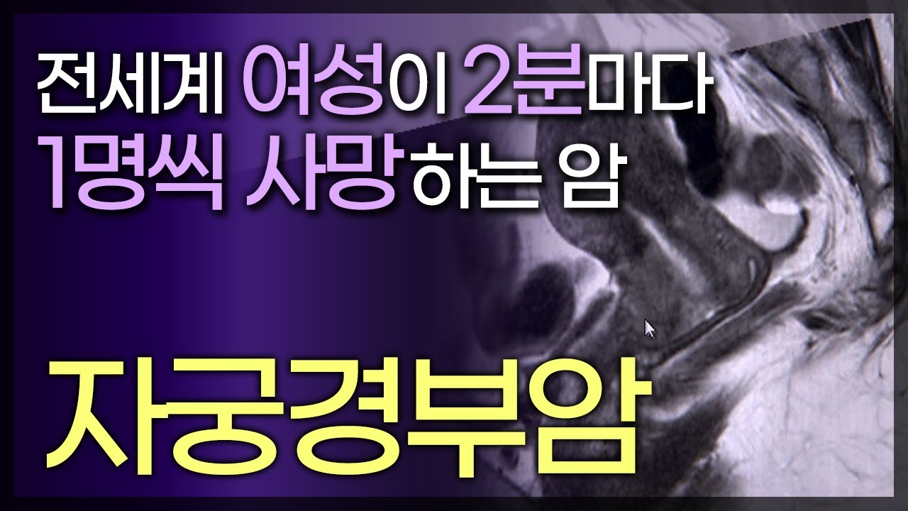 전세계 여성이 2분마다 1명씩 사망하는 자궁경부암/아랫배 통증,생리기간이 아닌데 하혈을 하면 자궁경부암을 의심해보아야 한다/인유두종바이러스(HPV) / 141010 tv닥터인사이드