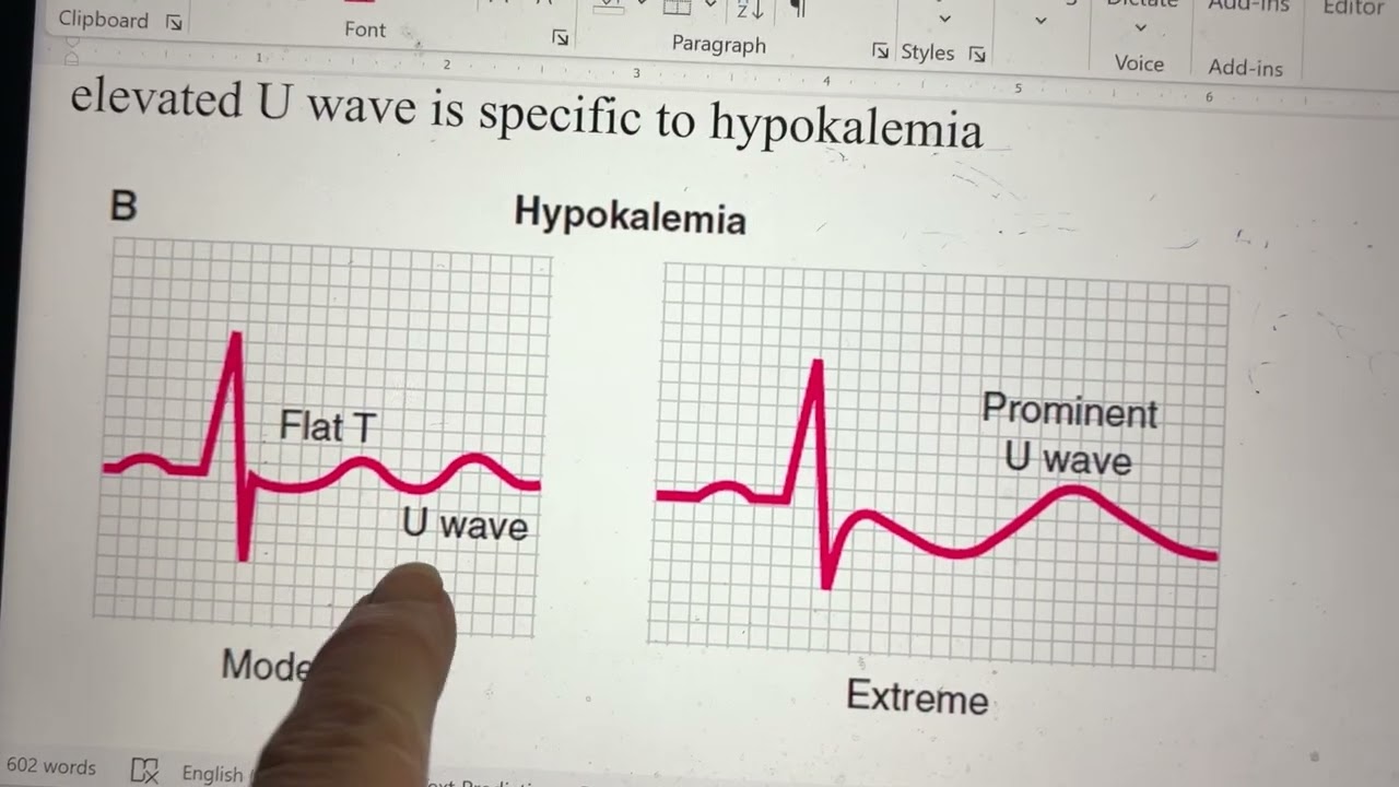 Potassium and EKG changes 