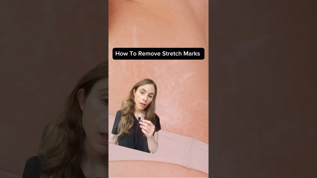 Effective Stretch Mark Creams - Bye Bye Stretch Marks!