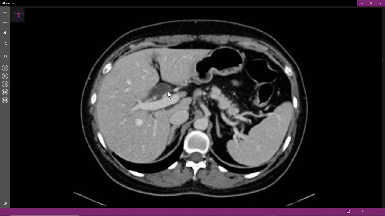 Carcinoma de pâncreas