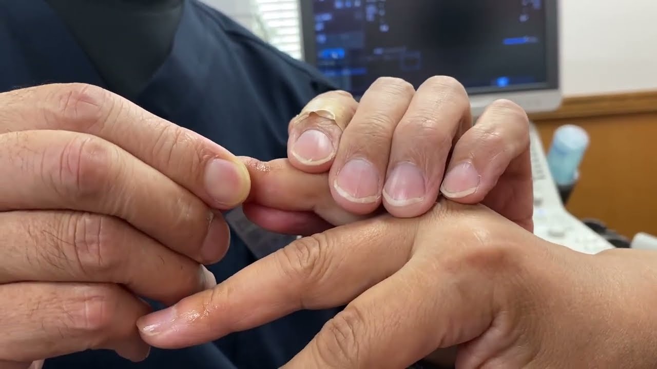DIP関節背側脱臼の整復