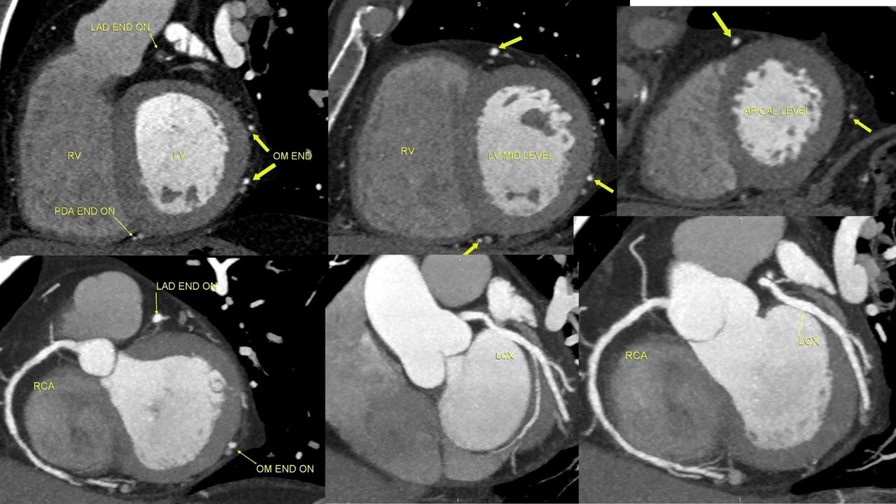 Triple rule out CT protocol