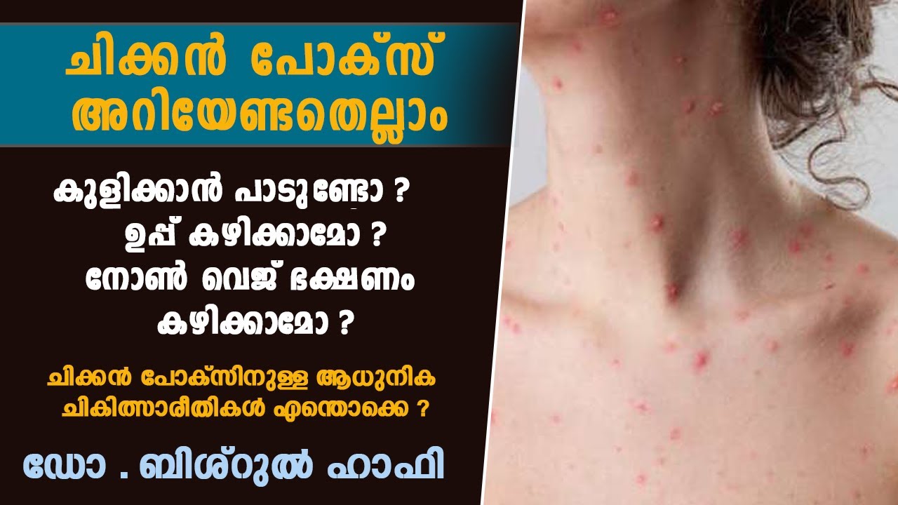 ചിക്കൻ പോക്‌സ് അറിയേണ്ടതെല്ലാം | Dr. Bishurul Hafi