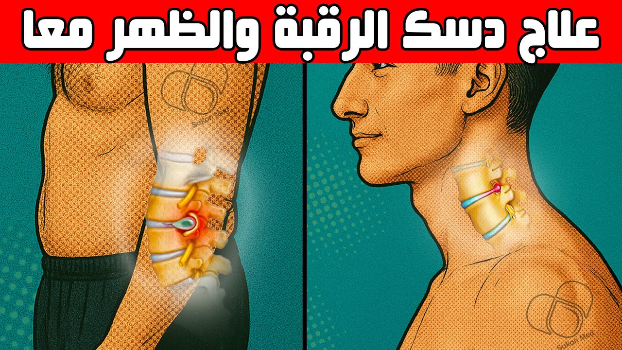 كيفية علاج انزلاق الدسك في الرقبة والظهر معا بـ 5 خطوات متكاملة