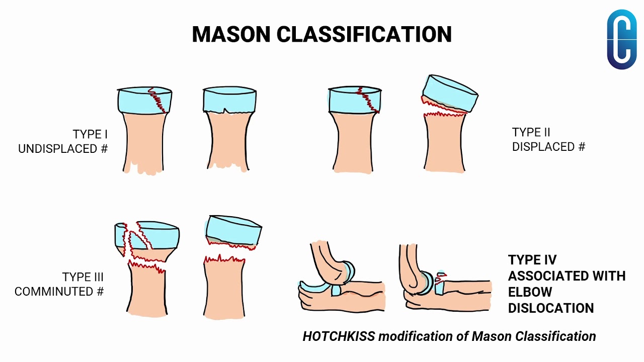 RADIAL HEAD FRACTURES | ORTHOPEDIC PG EXAM | CONCISE