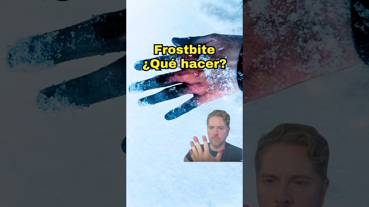 #frostbite Que hago si tengo las manos congeladas? - Doctores Especialistas