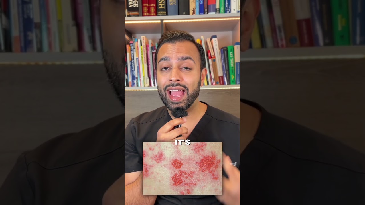 Shingles: painful rash from reactivated chickenpox virus. Early treatment is crucial. #Shingles
