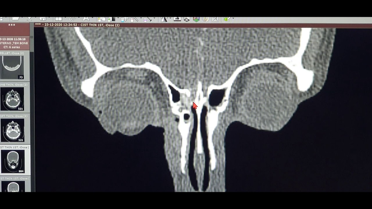 CSF Leak Right Cribriform | CT Cisternography | O.P.D case discussion # 10