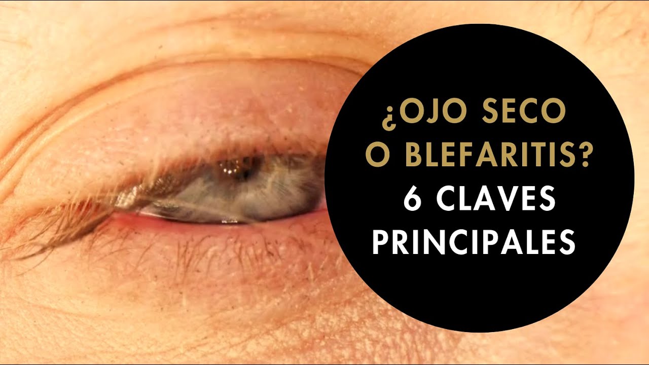 👀💧 OJO SECO vs. BLEFARITIS: ¿Sabes cuál tienes? Descúbrelo aquí 🔍✨