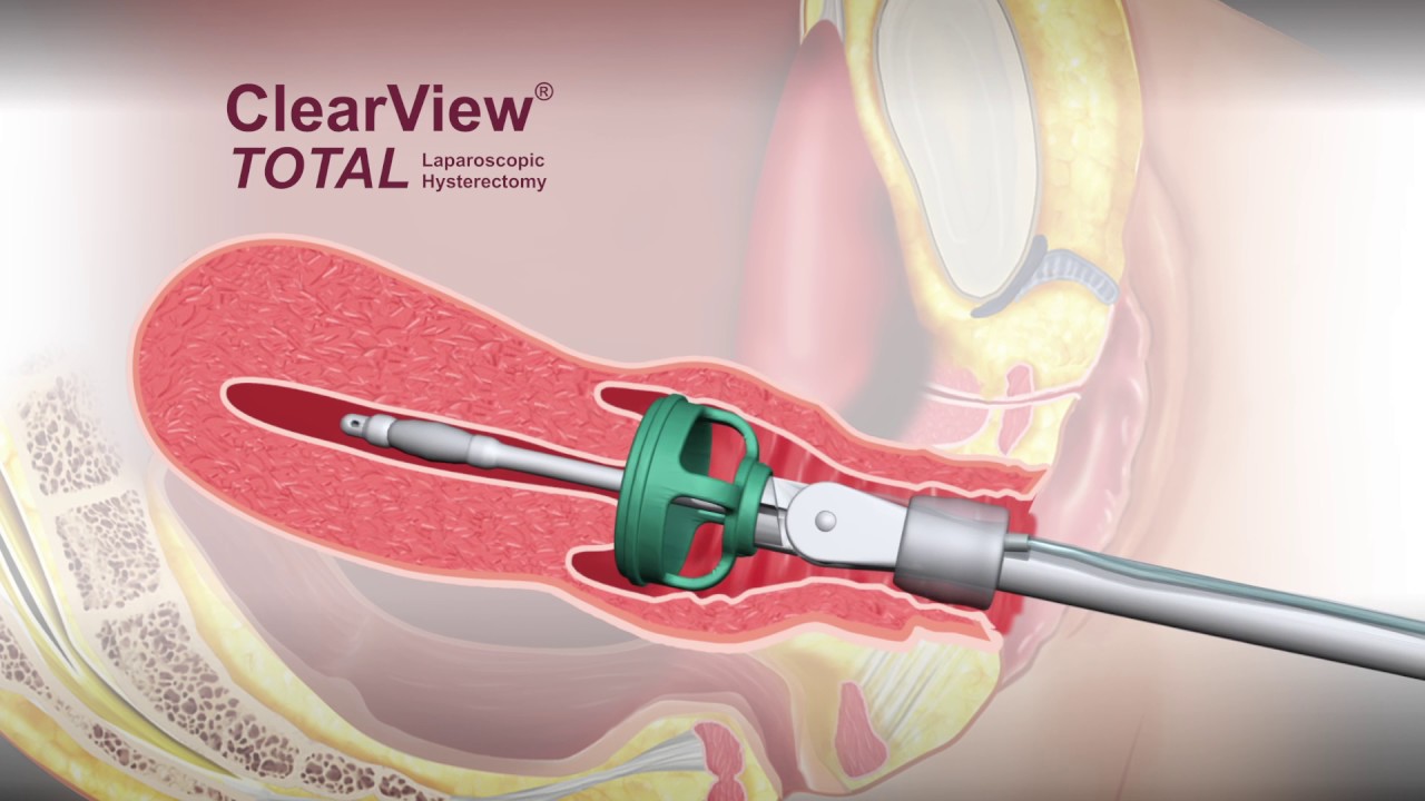 ClearView® TOTAL Uterine Manipulator - Animation