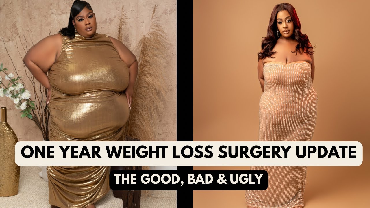 1 Year Weight Loss Surgery Update: The Good, Bad & Ugly