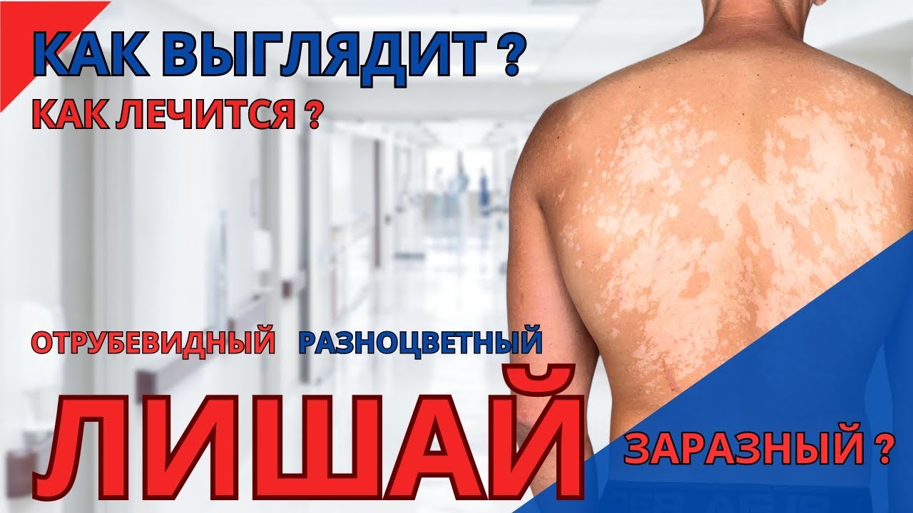 Лечение и профилактика отрубевидного лишая | Как выглядит разноцветный лишай