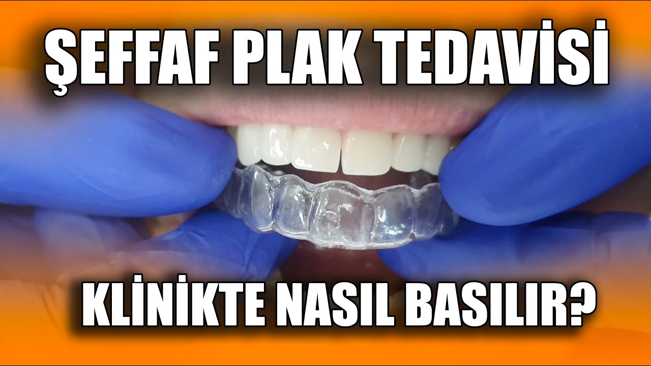 Klinikte Şeffaf Plak Basıp Ortodontik Hareket Nasıl Yapılır? Klinikte İnvisalign Yaptım!