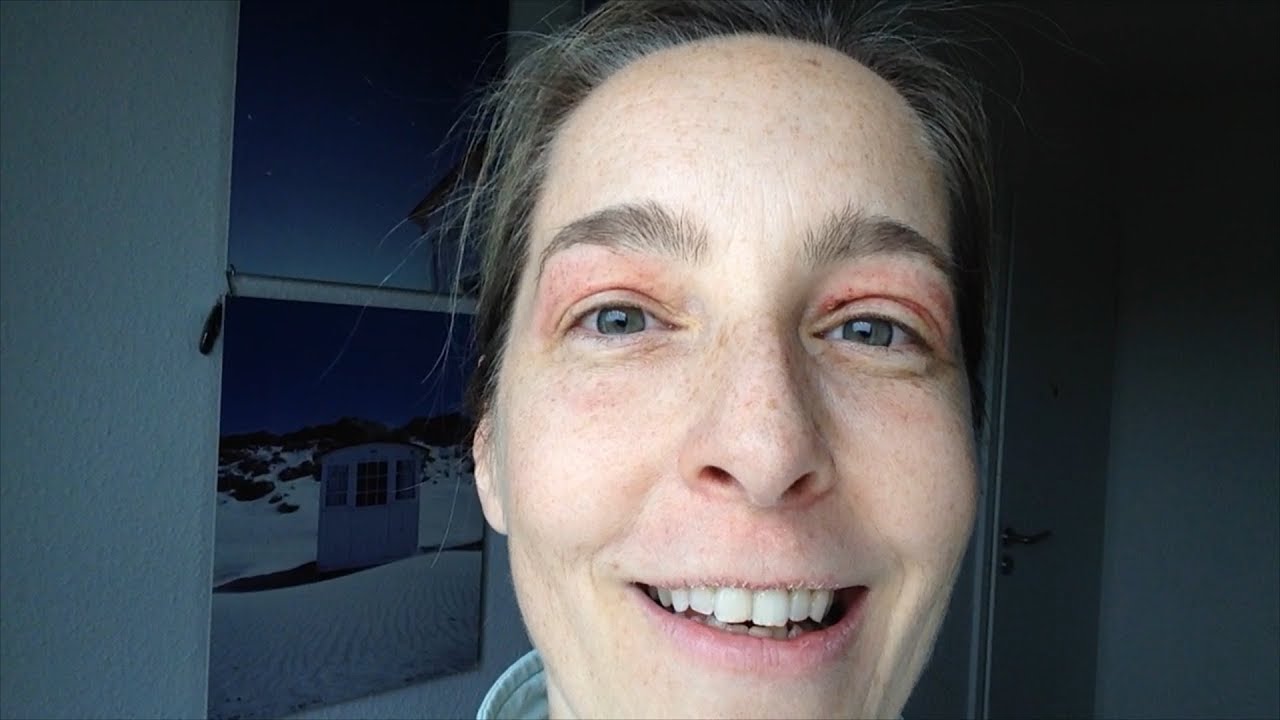 Augenlidstraffung ohne OP – eine Woche nach Laser Oberlid