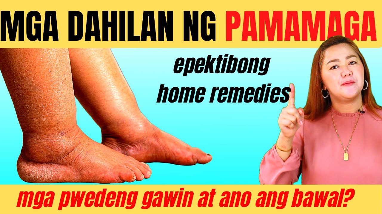 Pamamaga at Pamamanas sa Binti at Paa:  Anong Dapat Gawin at Ano ang Bawal? | Doc Cherry