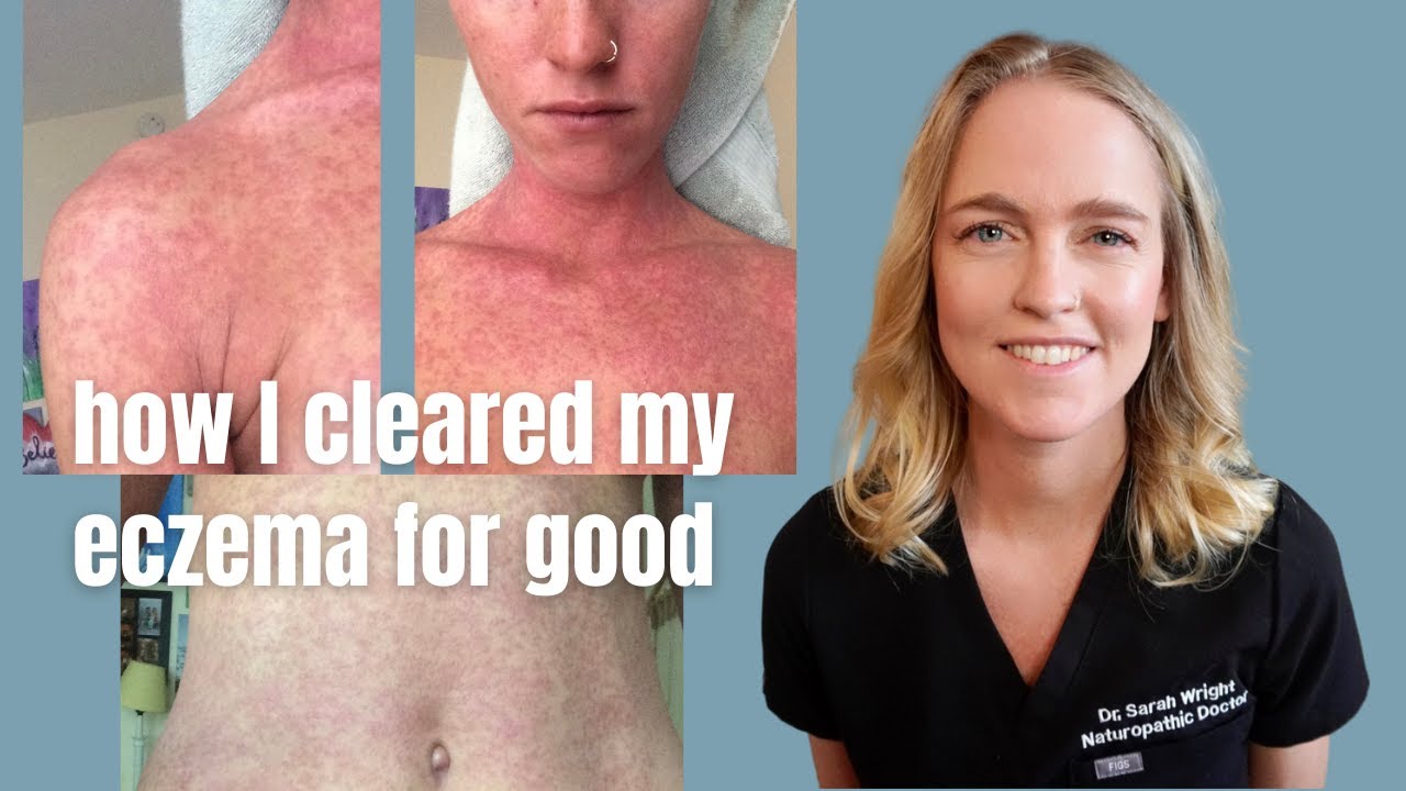 Natural Treatment for Eczema | How I Cleared My Eczema For Good