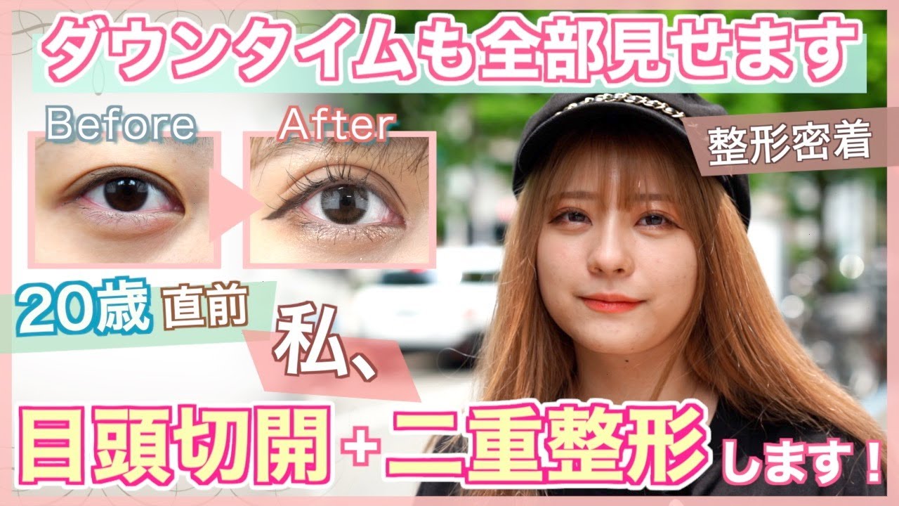 【二重整形+目頭切開】二重テープの幅を完全再現できる？痛みが怖い…傷跡が怖い…目頭切開の傷のリアルな経過を1週間全部見せ！【クイックコスメティーク・トリプル】