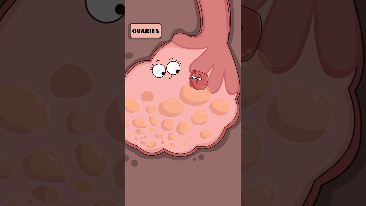 How are chocolate cysts formed? #health#didyouknow#shorts#funny#trending
