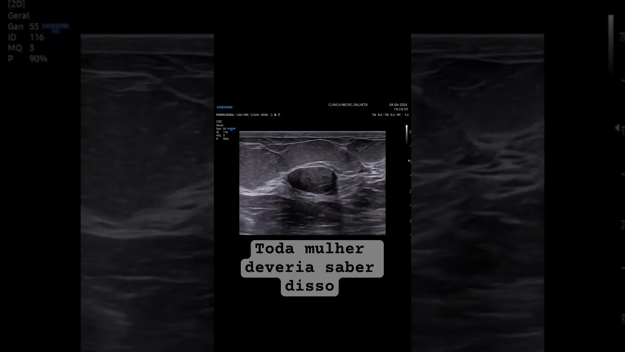 A diferen&ccedil;a entre o c&acirc;ncer de mama e o n&oacute;dulo benigno