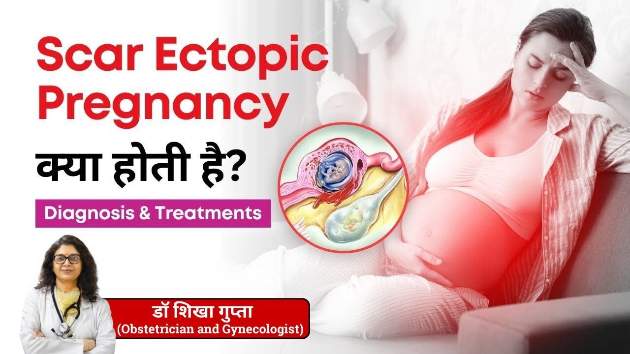Scar Ectopic Pregnancy क्या होती है? | Scar Ectopic Pregnancy के लक्षण और इलाज