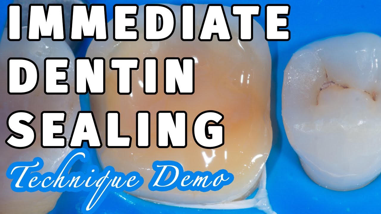 Biomimetic Dentistry- Immediate Dentin Sealing with Self-Etch DBA