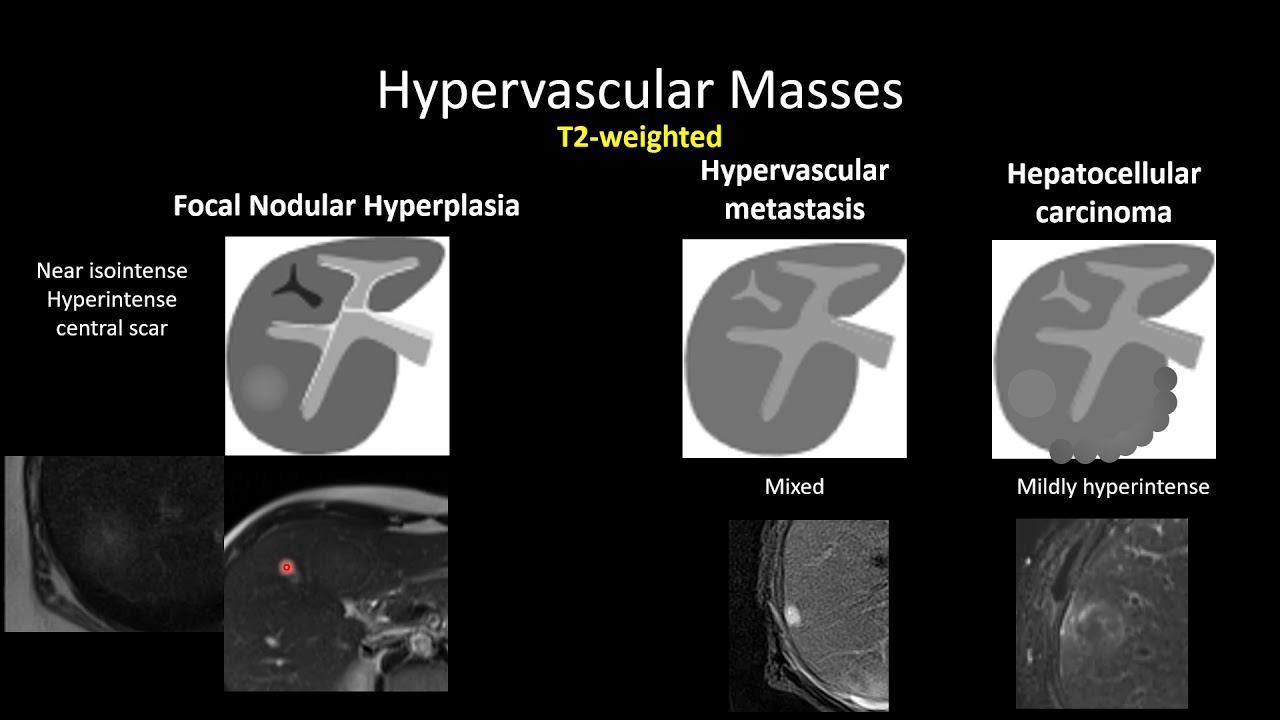 HyperVascular Masses of the Liver