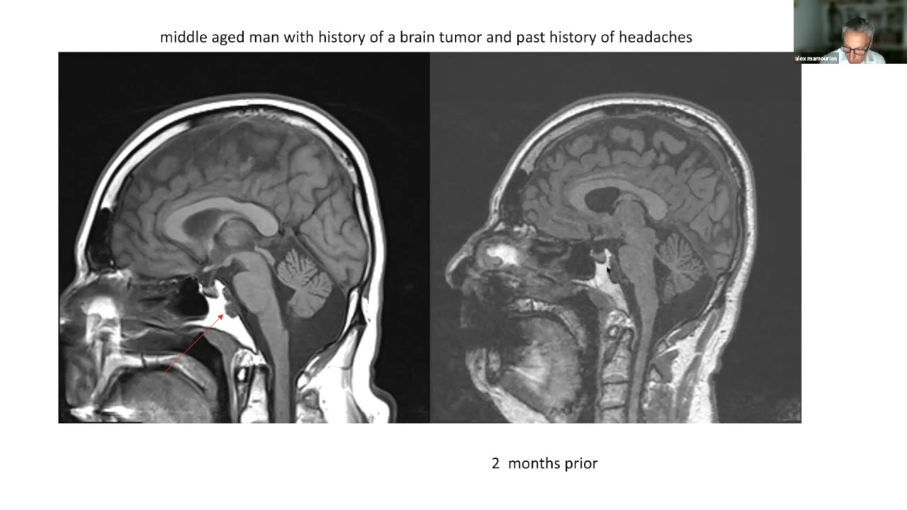 Approach to common skull base tumors   HD 720p