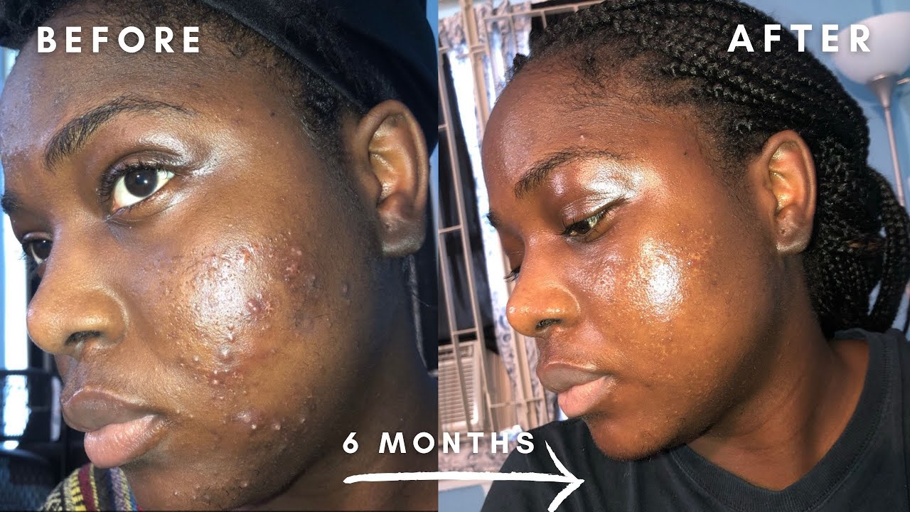 Differin Gel (Adapalene)| 6 Months Results| Before and After