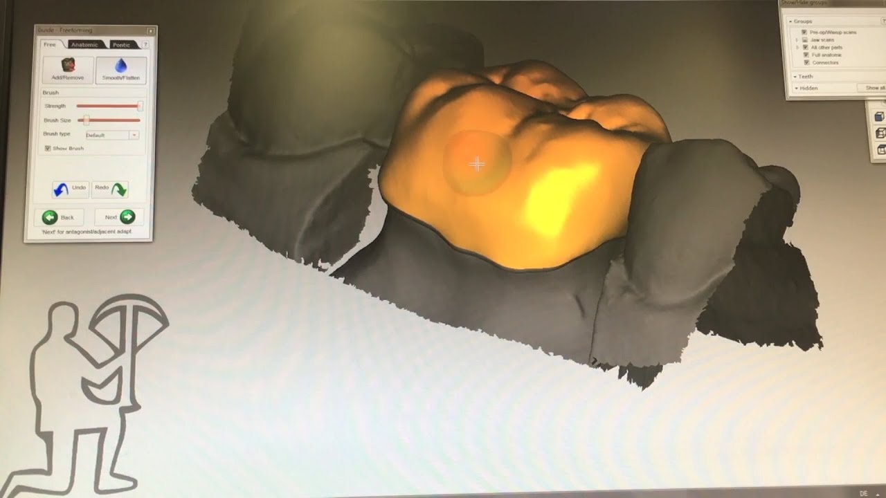 歯科用CAD/CAMによるクラウン製作の流れ