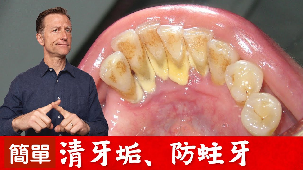 (牙齒3)天然自助清牙垢！預防蛀牙？柏格醫生 Dr Berg