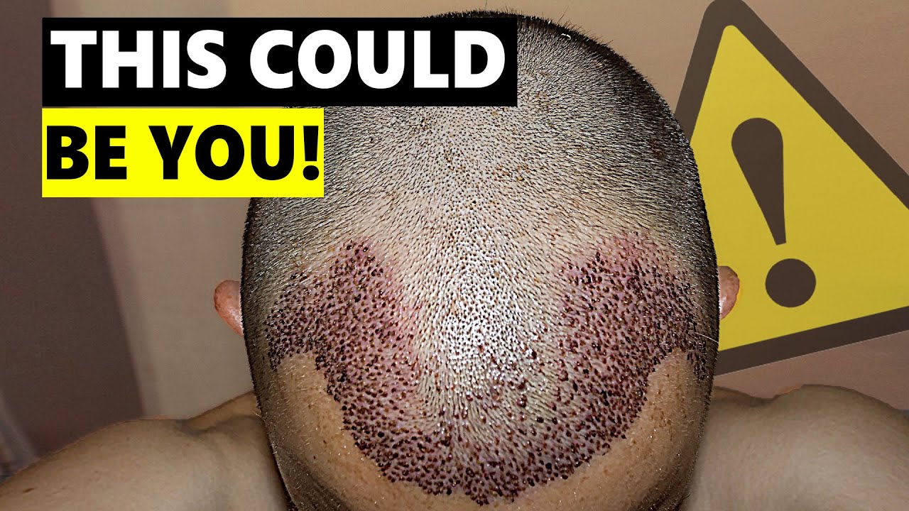 5 Things Went Incredibly Wrong with His Hair Transplant!